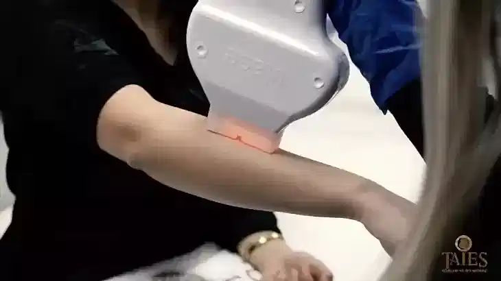 Lazer Epilasyonda Cihaz Seçimi